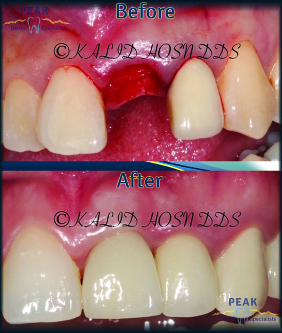 Periodontic Before and After